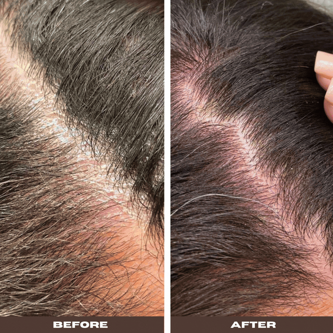 Seborrheic Itch Relief Scalp Solution | Probiotic Leave-in