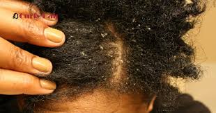 Combatting Dry Scalp This Winter: The Power of Prebiotics - Bea's Bayou Skincare