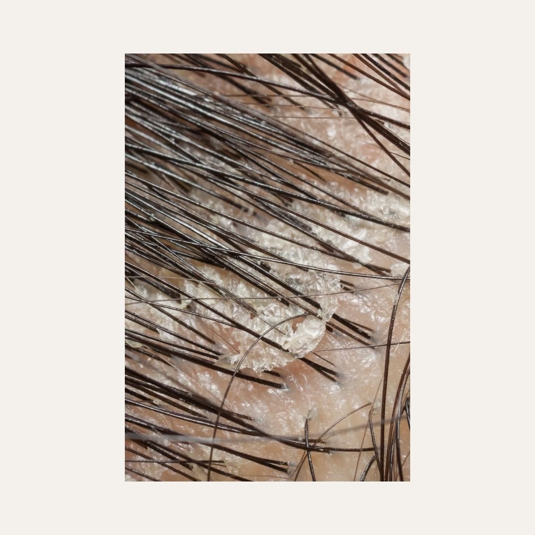 Dandruff vs Seborrheic Dermatitis vs Dry Scalp- What's the Difference - Bea's Bayou Skincare