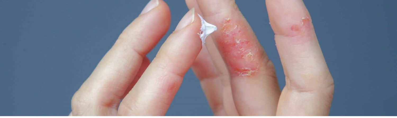 Nourishing Skin from Within: Dietary Needs for Eczema Relief - Bea's Bayou Skincare