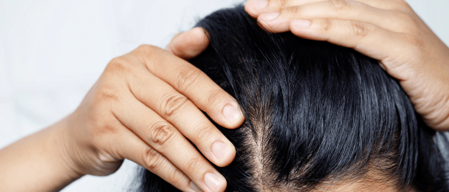 Skincare Purging: Why Your Scalp May Flake More Before It Gets Better - Bea's Bayou Skincare