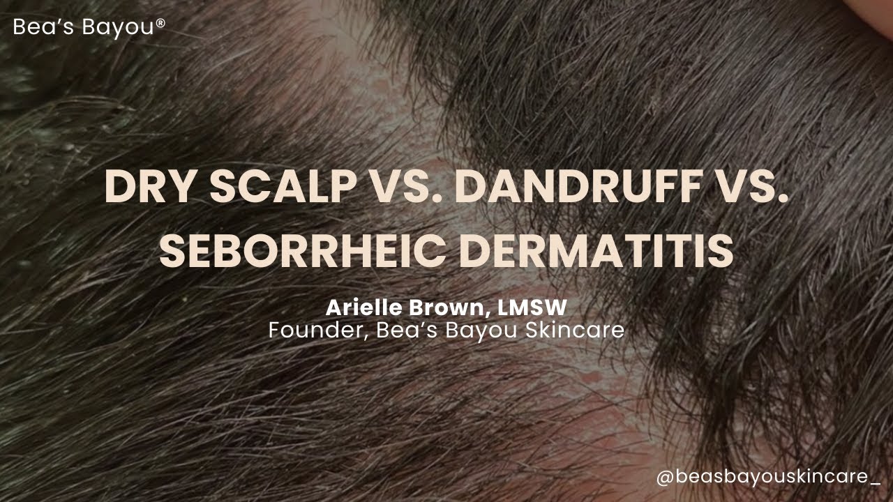 Load video: dry scalp vs dandruff vs seborrheic dermatitis