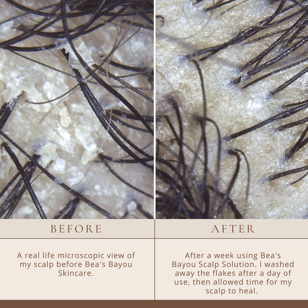Good Biome Seborrheic Scalp Solution (DUO): Herbal Prebiotic Leave - in - Bea's Bayou Skincare